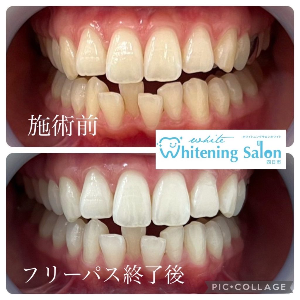 新価格！サロン仕様！歯のホワイトニング 美容ホワイトニング - 美容/健康